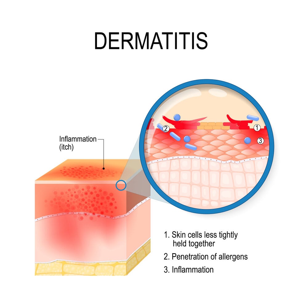 Psoriasis Vs Eczema Lets Understand The Difference 6200