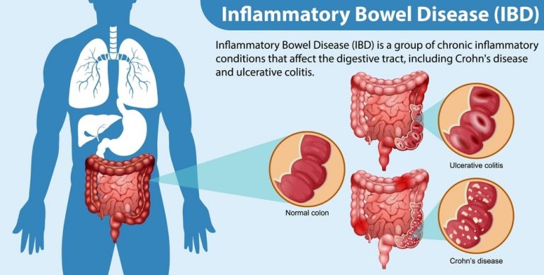 Is Inflammatory Bowel Disease Autoimmune? Read More Now...