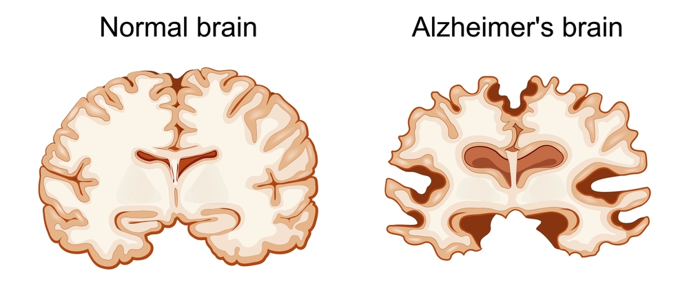 Signs And Symptoms Of Alzheimer’s Disease