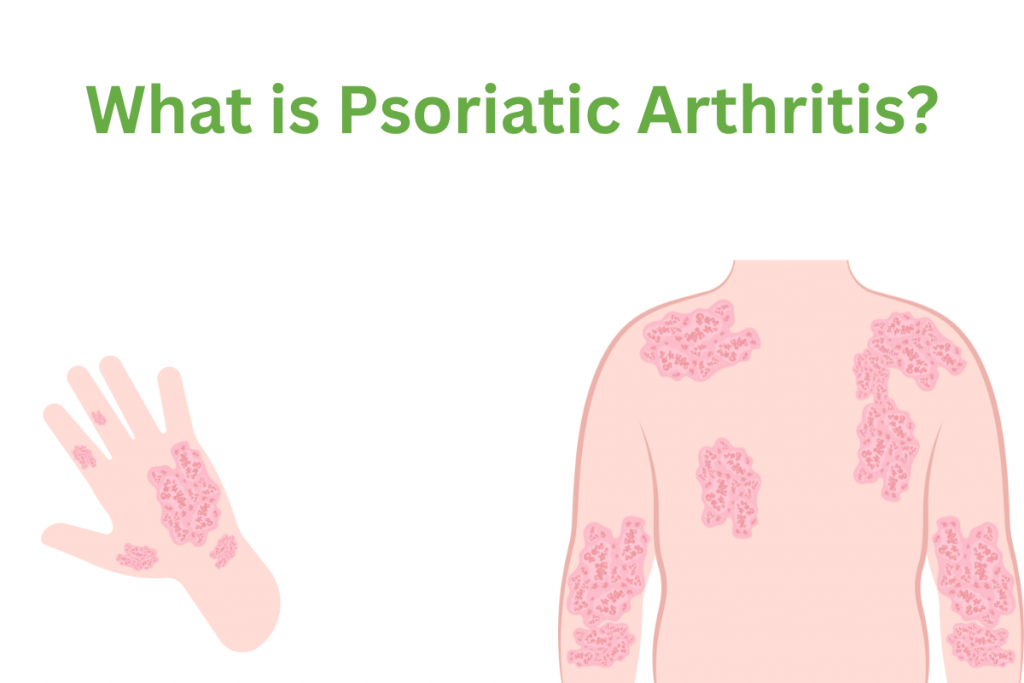 What is Psoriatic Arthritis